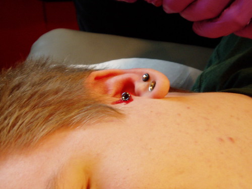 piercing infection. Tragus Piercing Infection